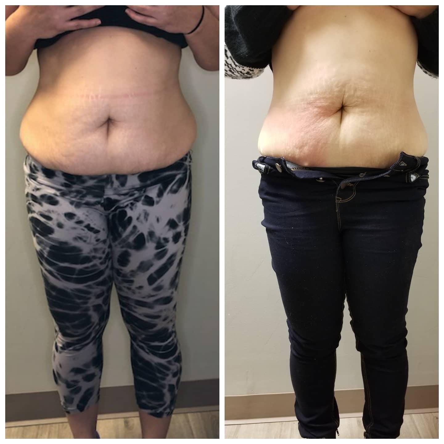 Side-by-side abdomen photos; before with tie-dye pants, after with jeans. Reduced belly fat visible in the after photo.