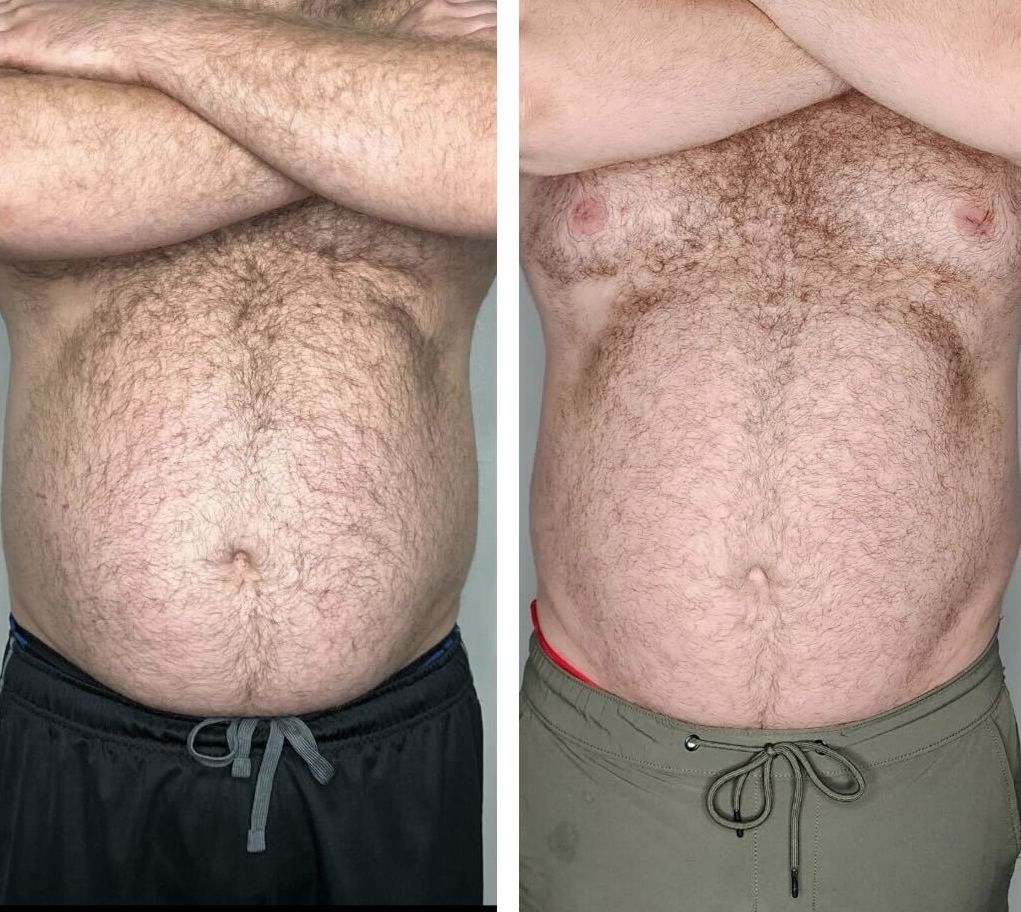 Side-by-side before and after photos of a person's torso. Shows abdomen with dark hair, a change in size.