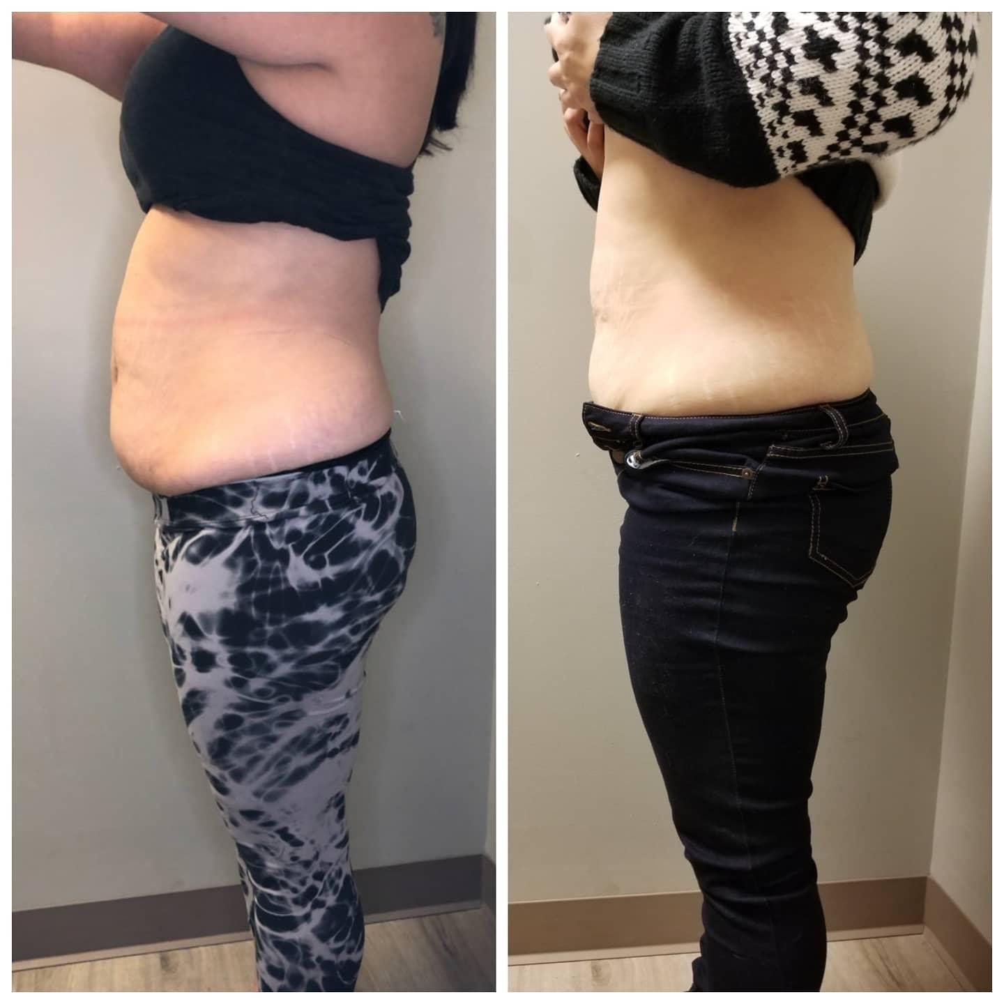 Side-by-side comparison showing a person's abdomen before and after weight loss.