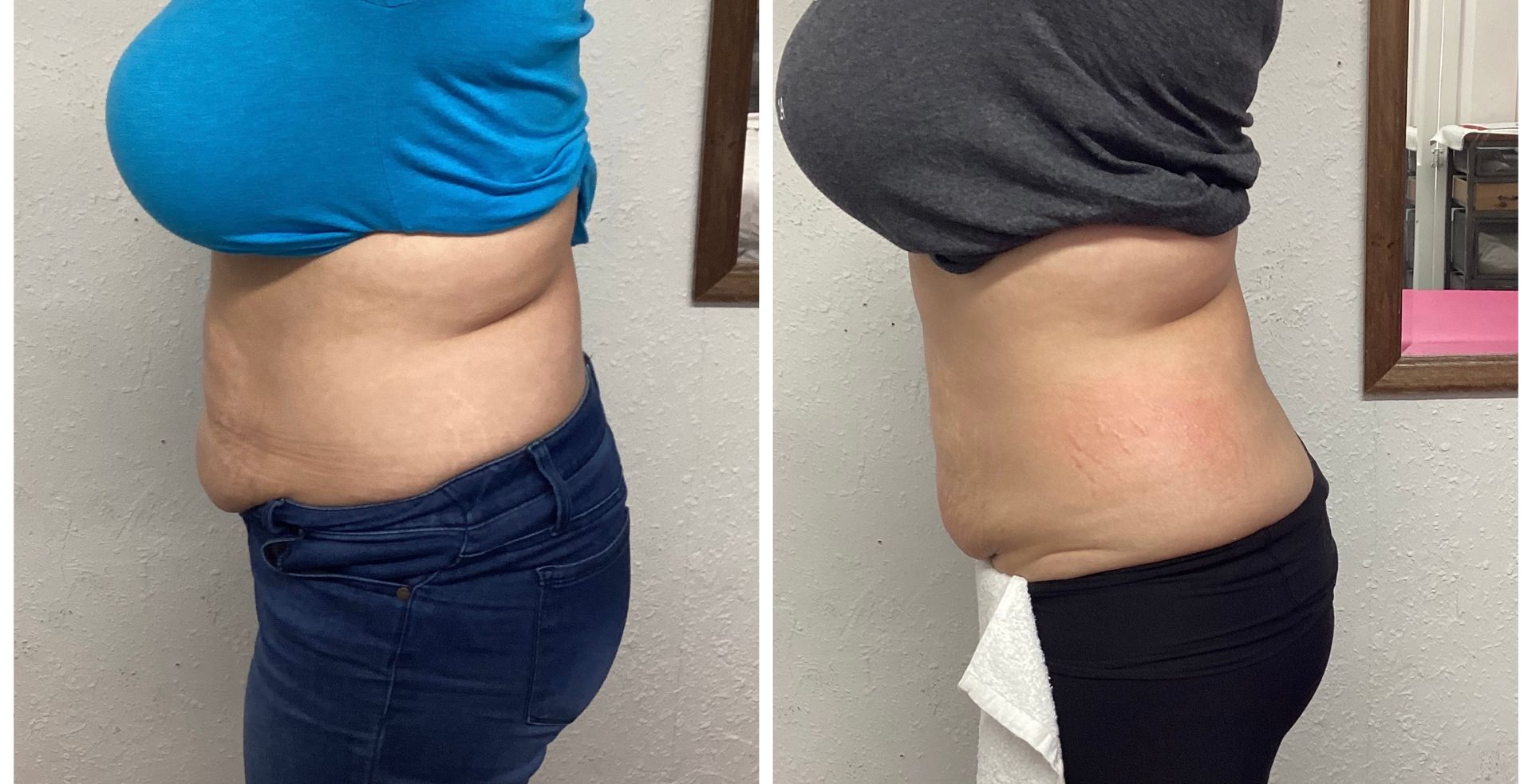Before and after photos showing a person's side profile with a smaller waist and a reduced belly fat.