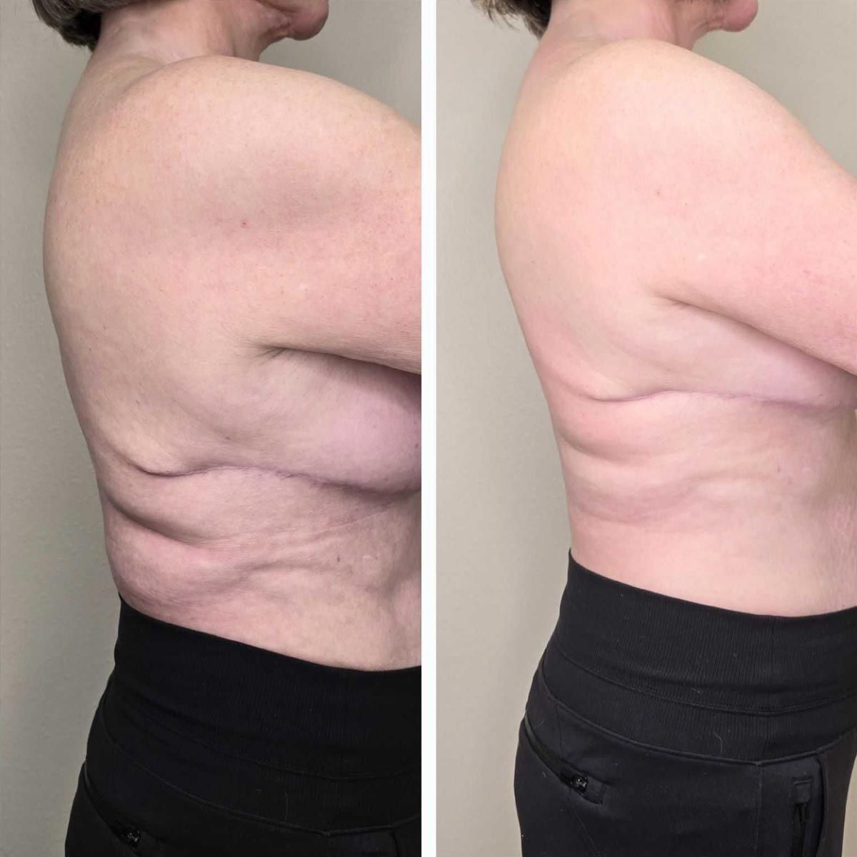 Before and after photos of a person's side torso. The left photo shows excess skin, the right shows tighter skin