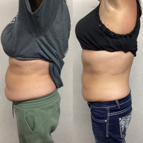 Side-by-side photos of a woman, showing a visible decrease in abdominal fat.