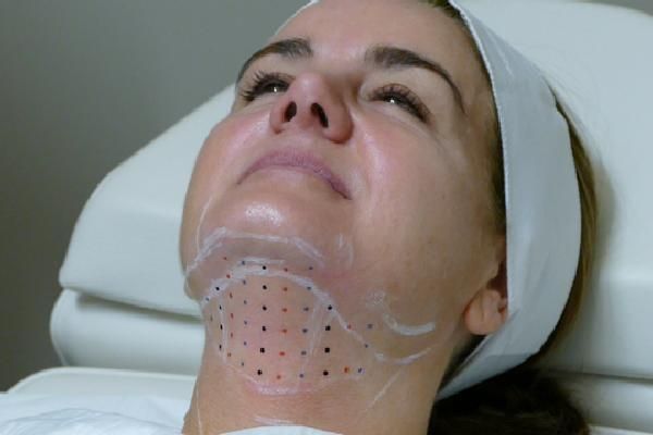 Woman with face marked for a cosmetic procedure. Black dots and lines indicate treatment areas.