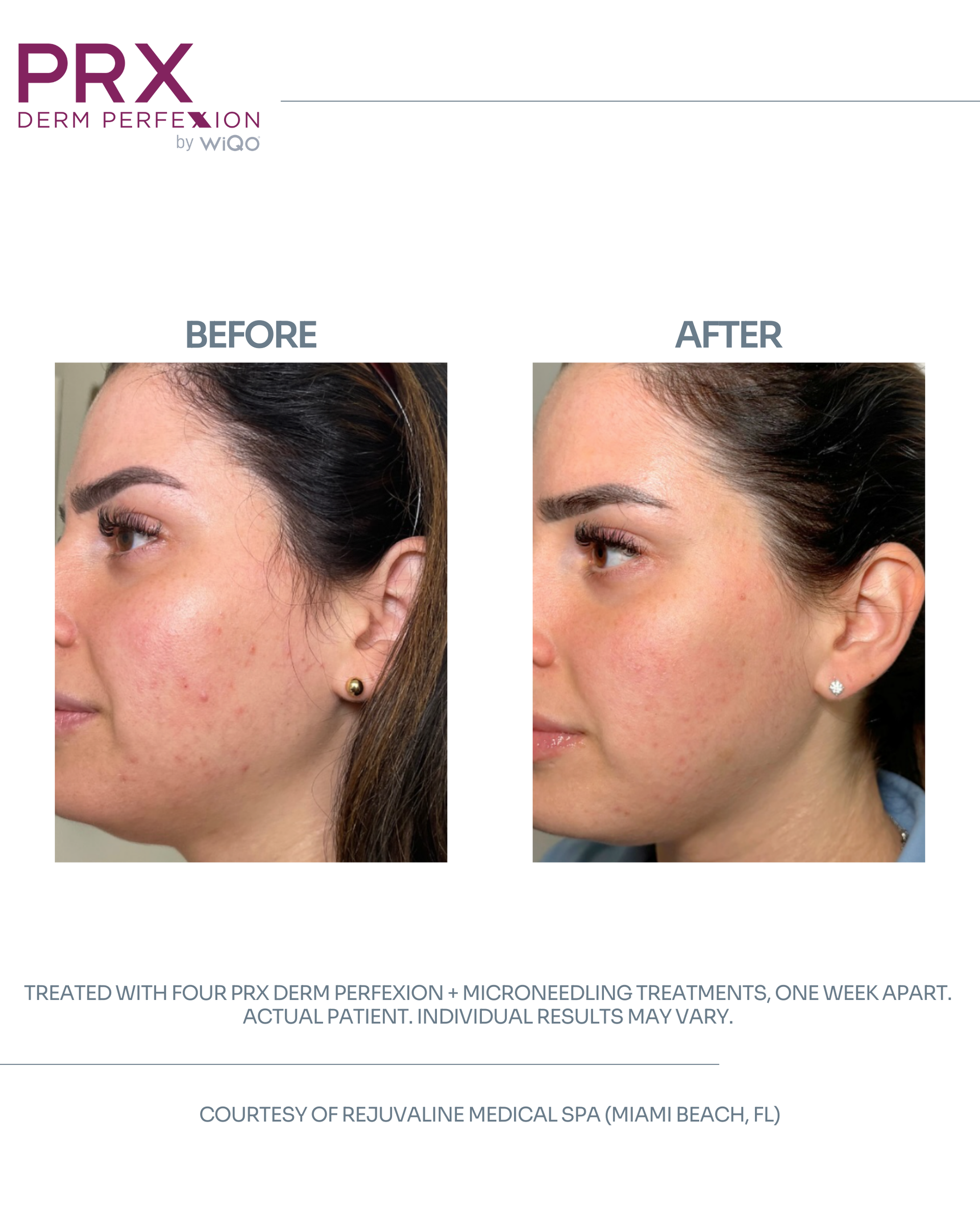 Actual MAX MD patient before and after PRX Derm Perfexion and microneedling