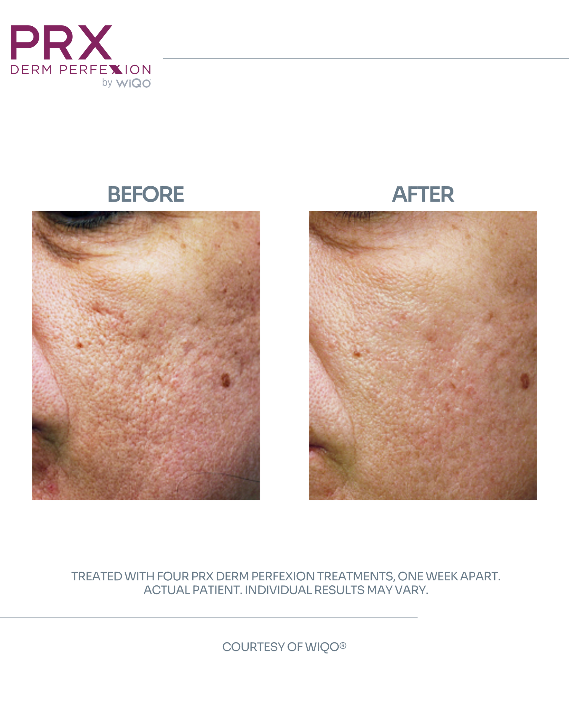 Actual MAX MD patient before and after four PRX Derm Perfexion treatments