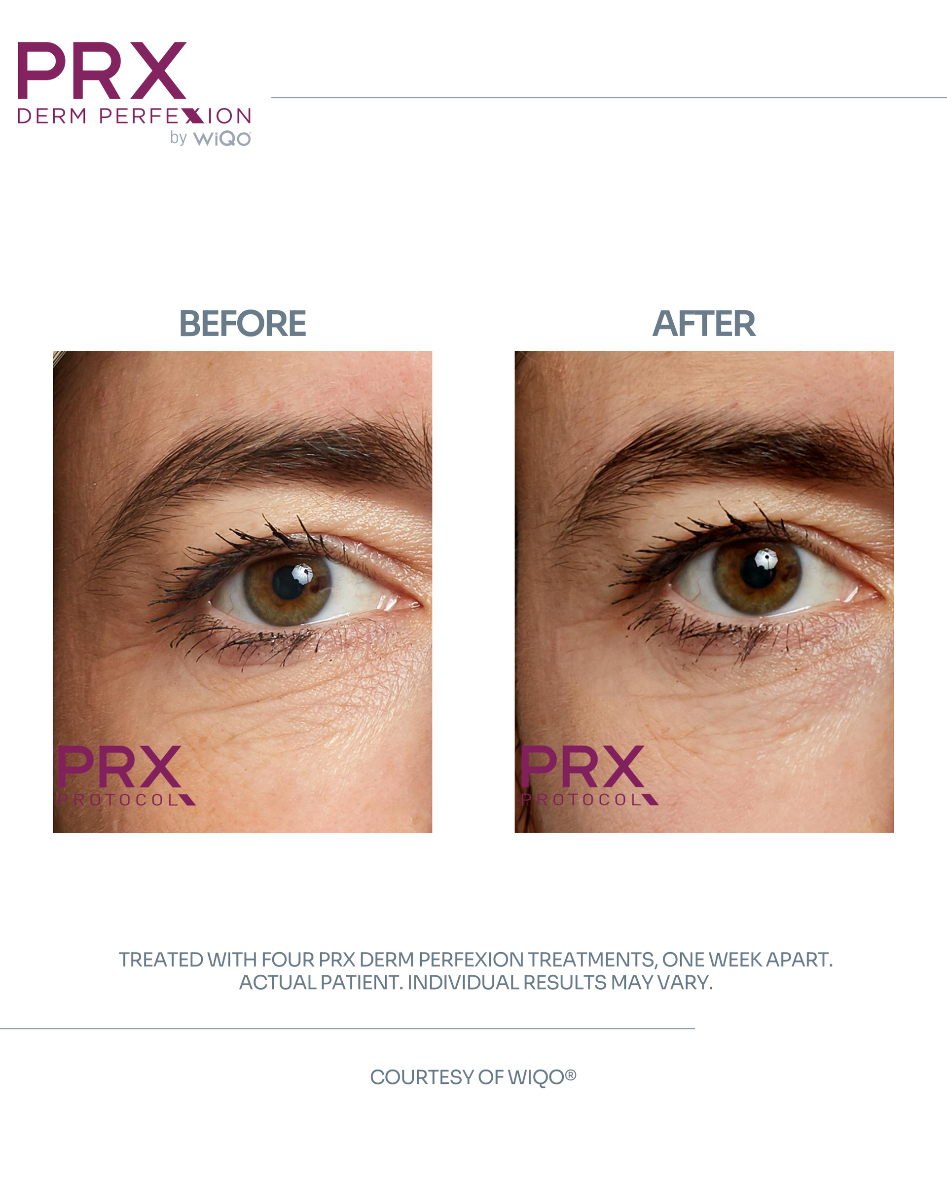Actual MAX MD patient before and after four PRX Derm Perfexion treatments
