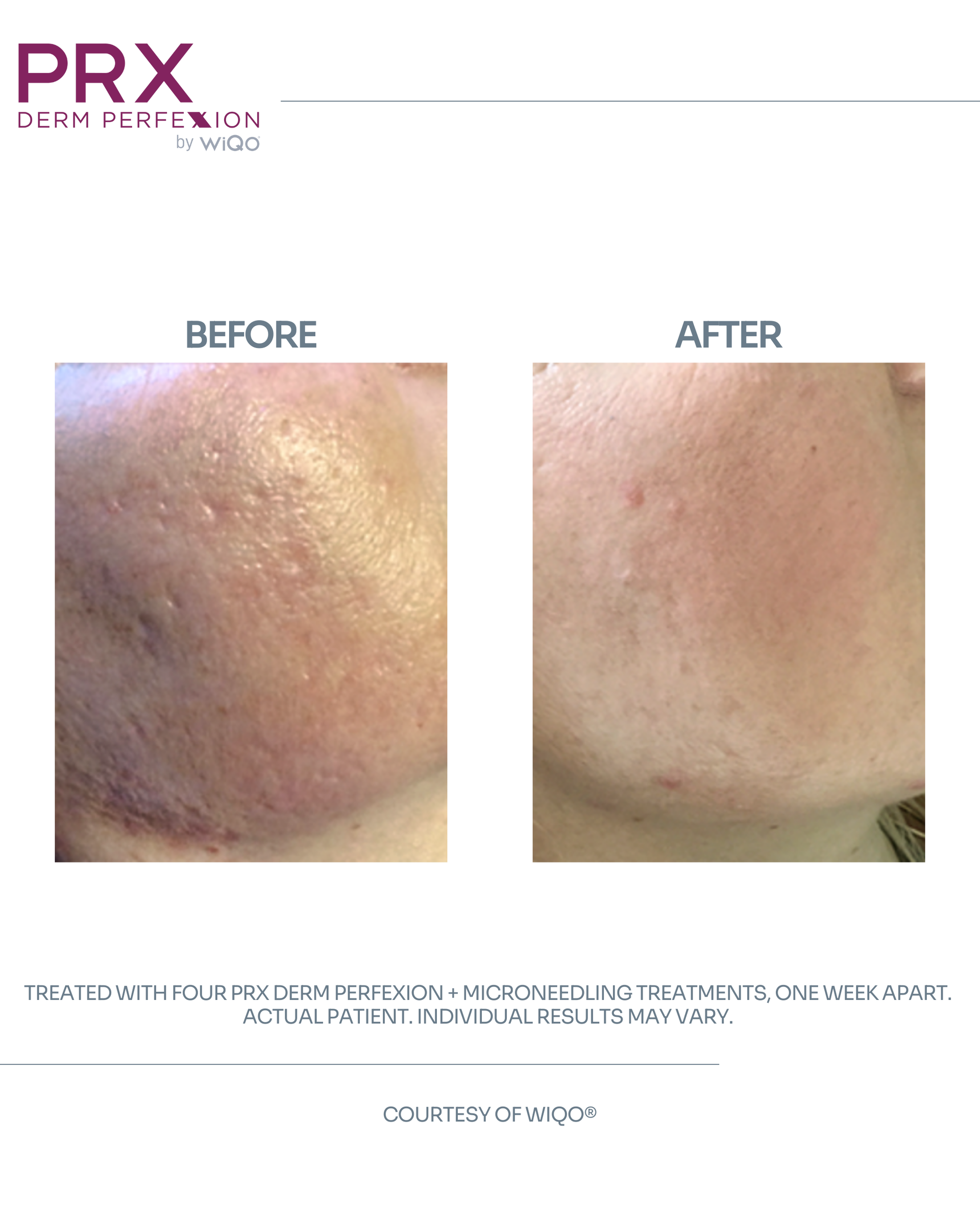 Actual MAX MD patient before and after PRX Derm Perfexion and microneedling