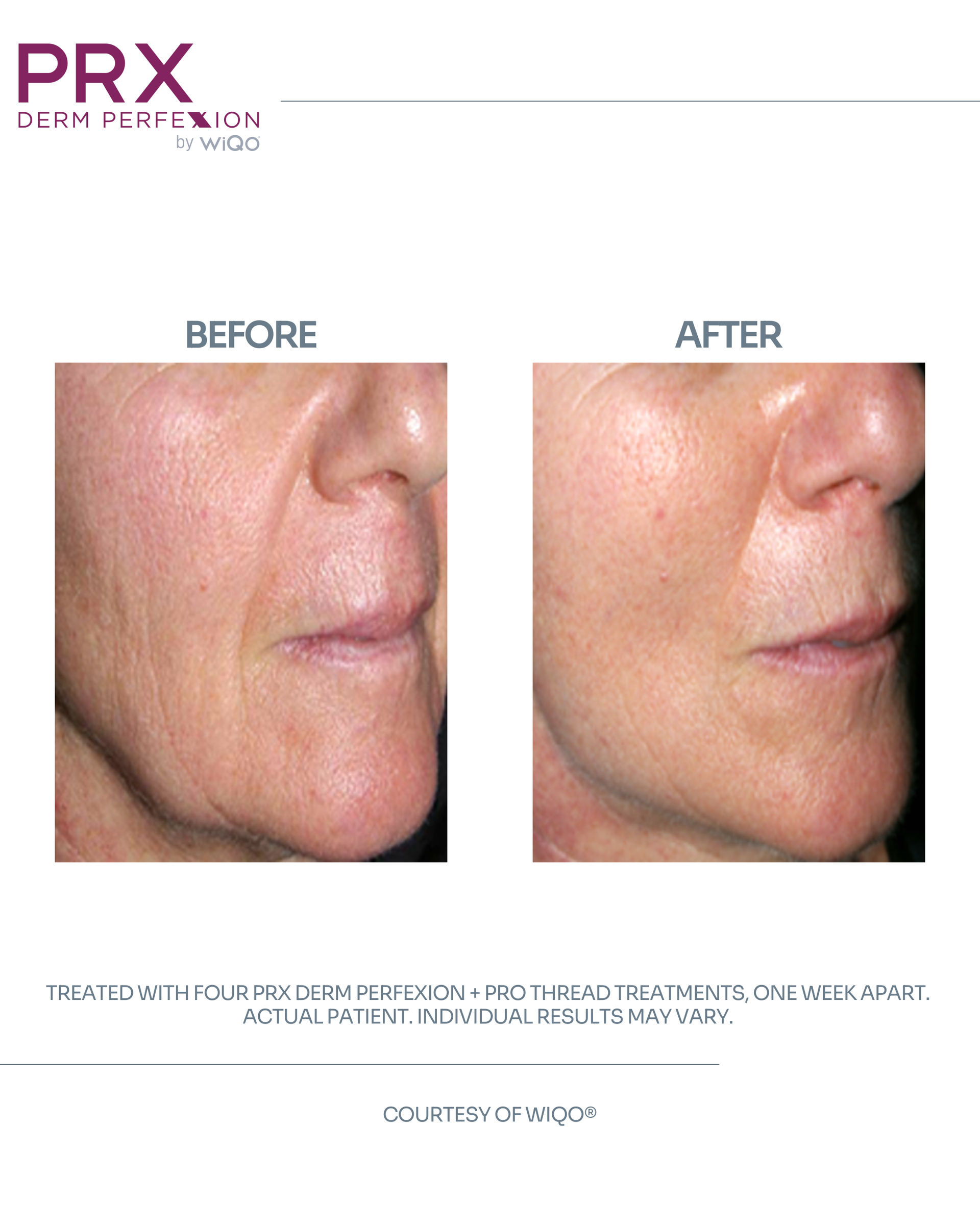 Actual MAX MD patient before and after PRX Derm Perfexion and PDO threads