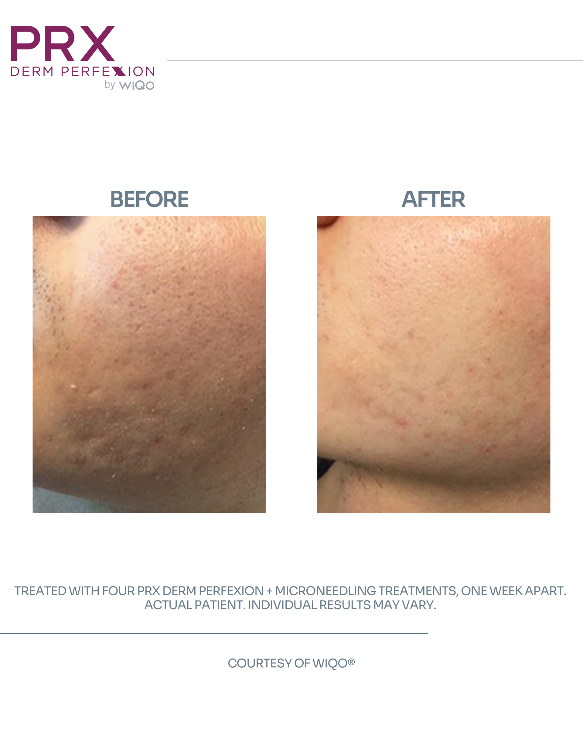 Actual MAX MD patient before and after PRX Derm Perfexion and microneedling