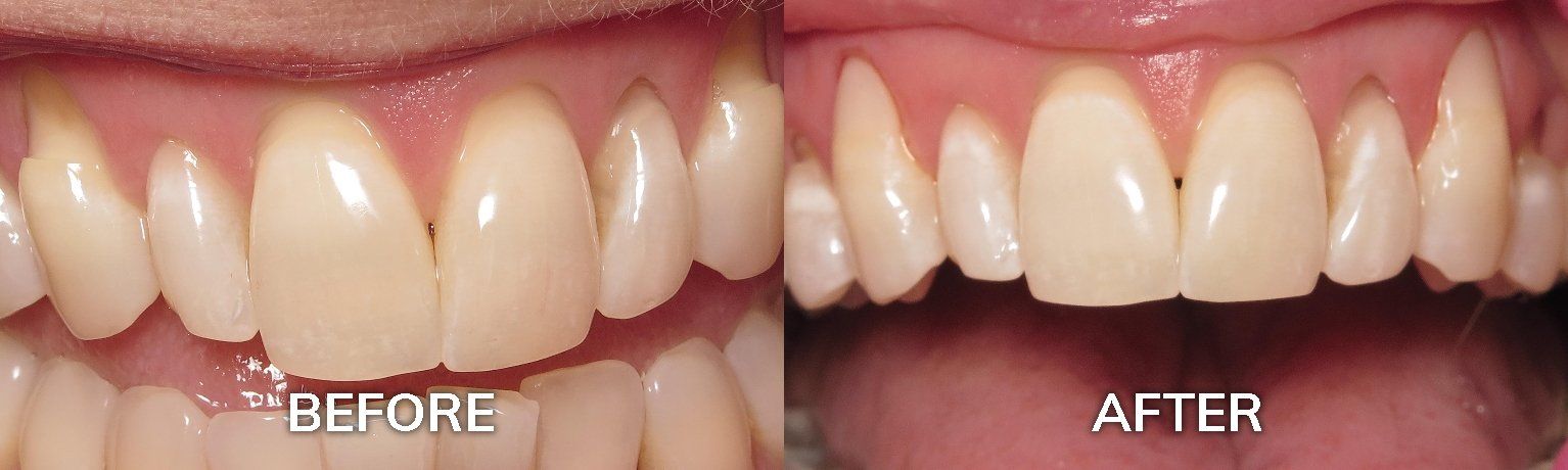 Dental Bonding for Sensitive Teeth | Before and After Photo | Tuscaloosa AL