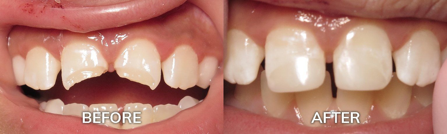 Dental Bonding Before and After | Best Dentist in Tuscaloosa AL