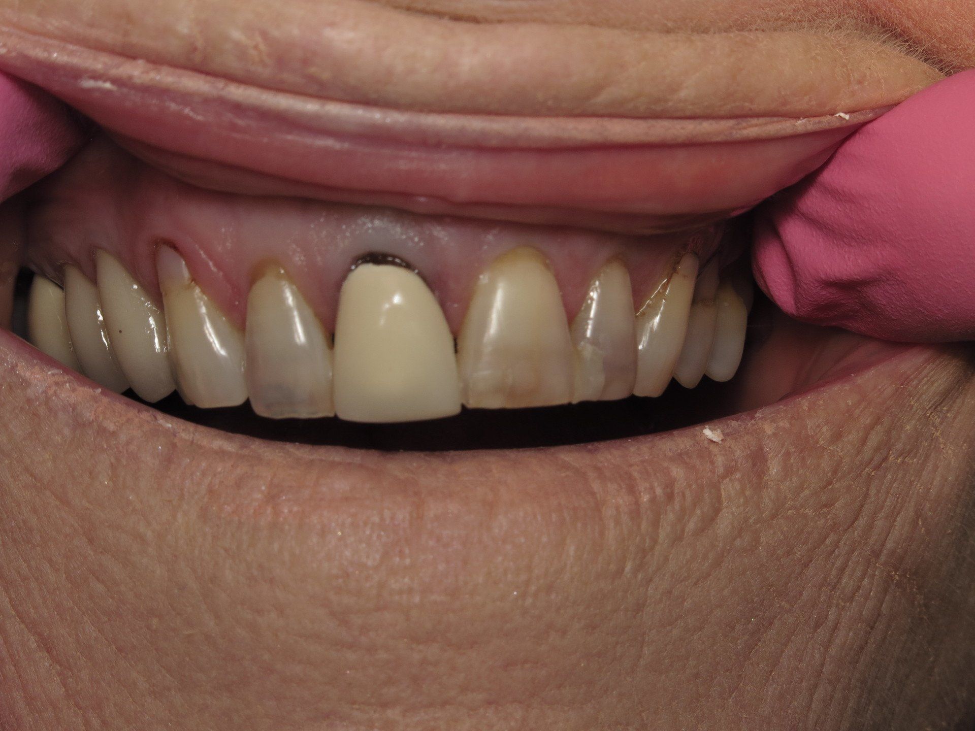 Dental Bonding Sensitive Teeth Before Photo | Tuscaloosa AL