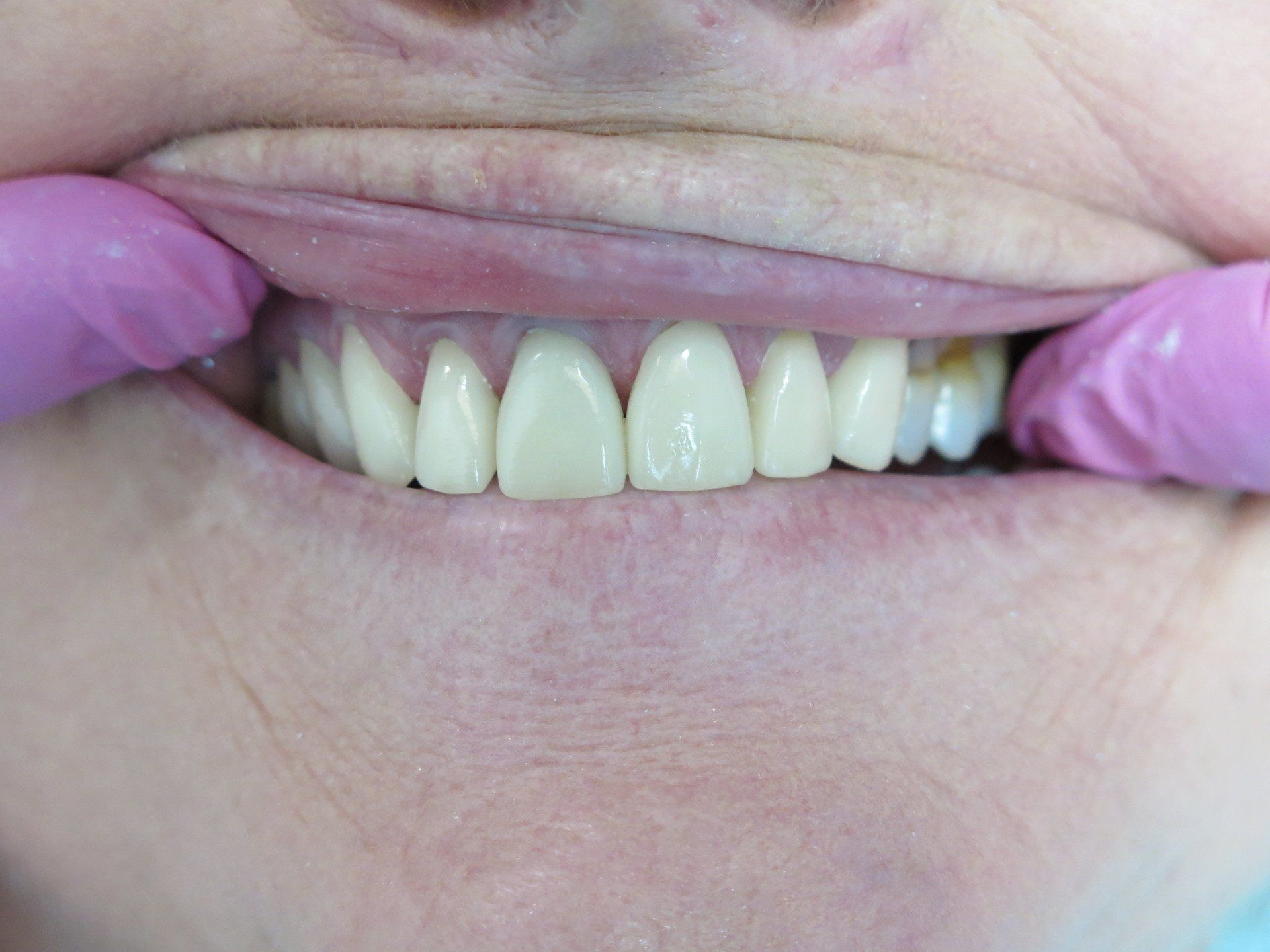 Bonding Sensitive Teeth | After Photo | Dentist Tuscaloosa AL