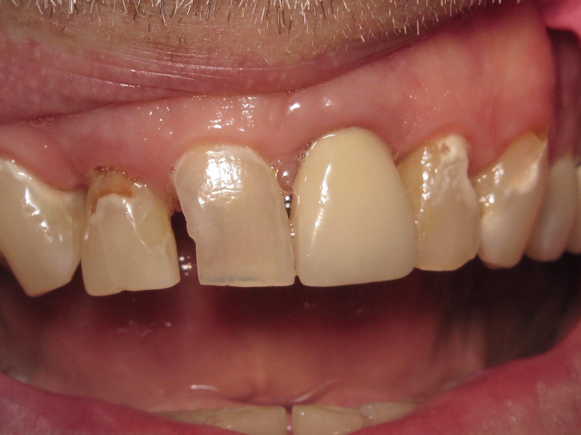 Bonding Sensitive Teeth | Before Photo | Tuscaloosa AL Top Dentist