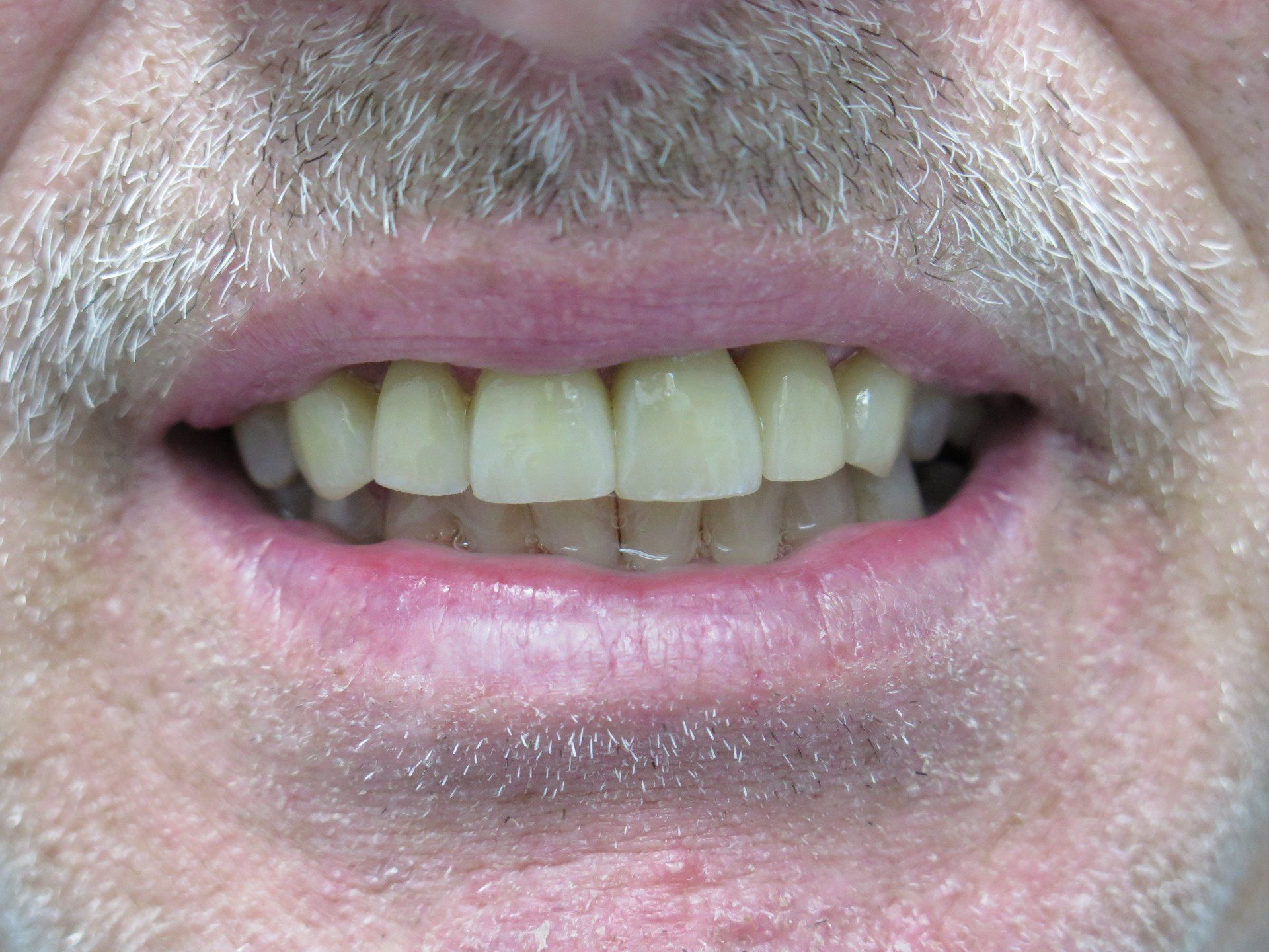 Dental Bonding Sensitive Teeth After Photo | Tuscaloosa AL Dentist