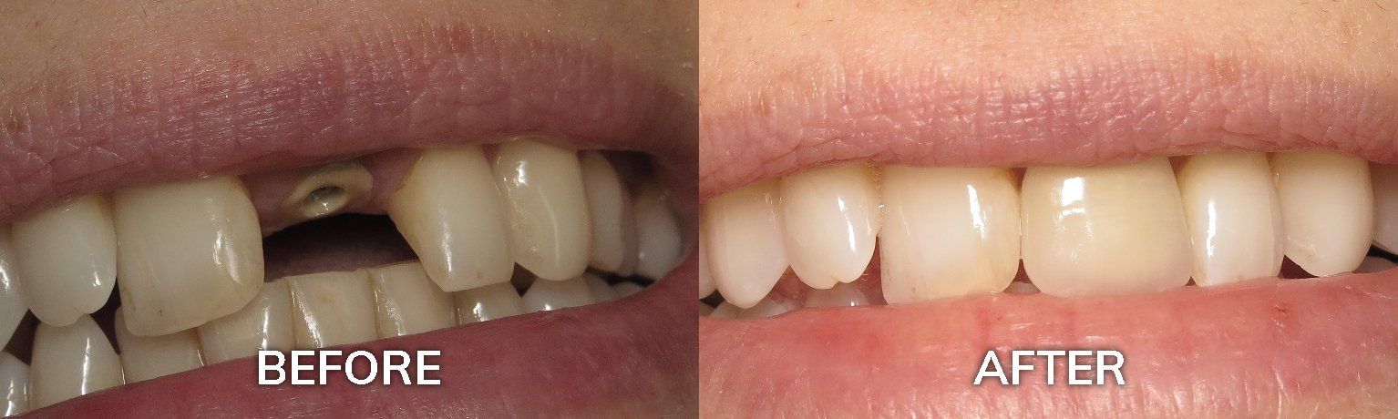Before and After Dental Implants | Restorative and Cosmetic Dentist Tuscaloosa AL