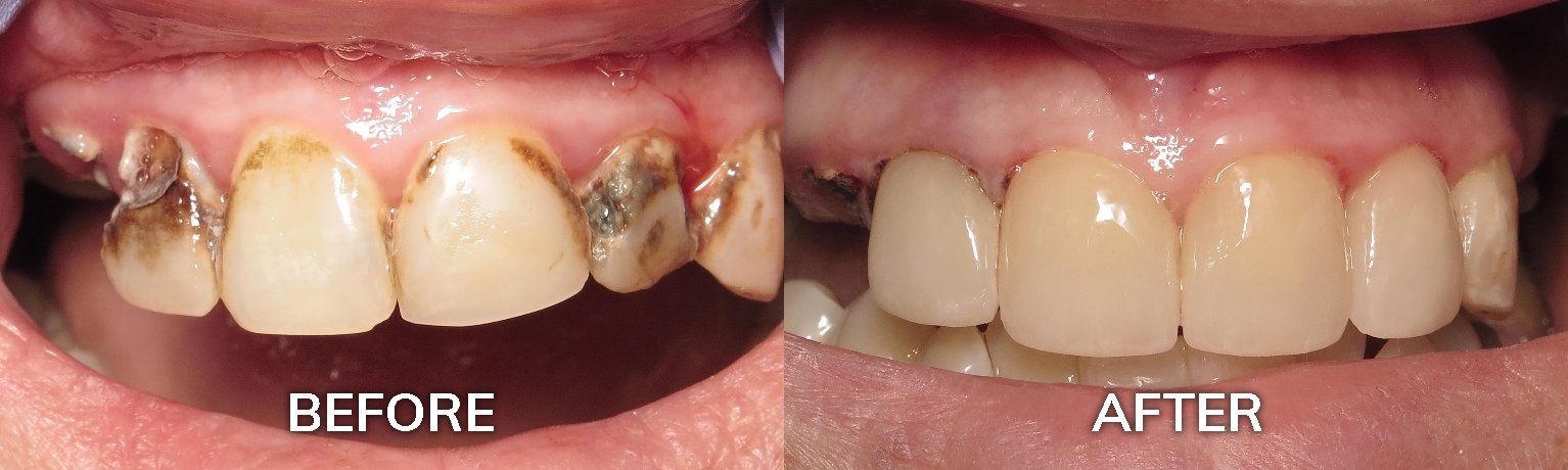 Maxillary Arch Reconstruction Before and After | Tuscaloosa AL