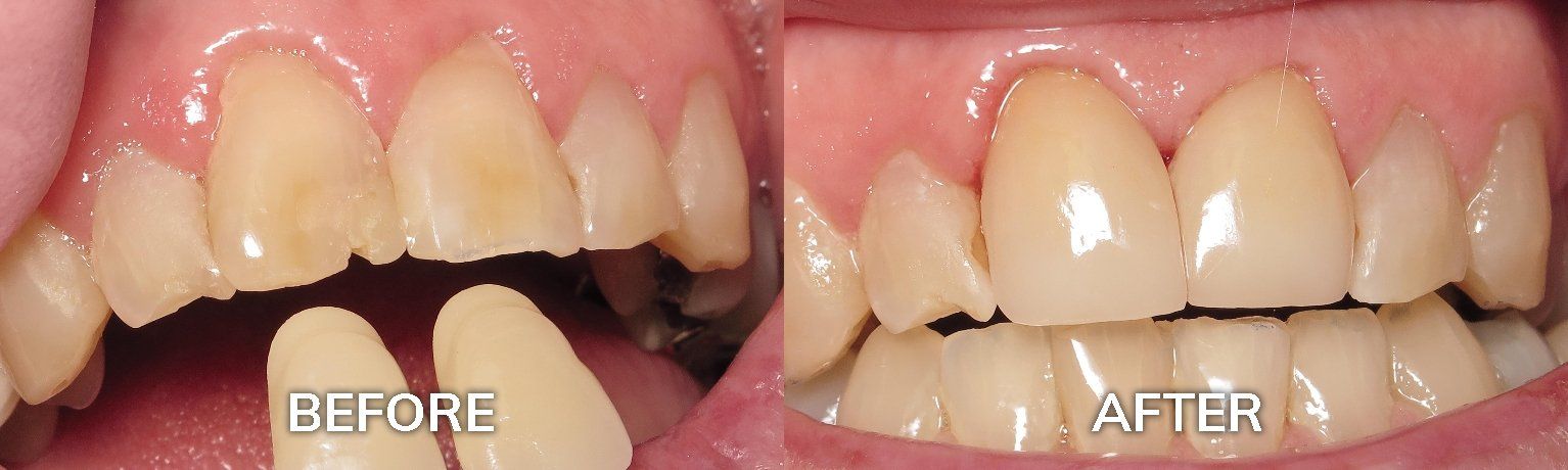 Porcelain Crowns | Dental Crowns Before and After | Adult and Pediatric Dentist Tuscaloosa AL