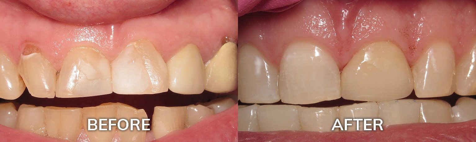 Porcelain Dental Crowns Before and After | Tuscaloosa AL Adult and Pediatric Family Dentist