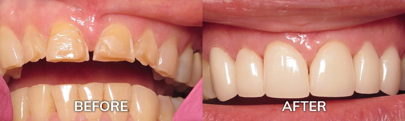 Porcelain Crowns Before and After | Dental Crowns Tuscaloosa AL
