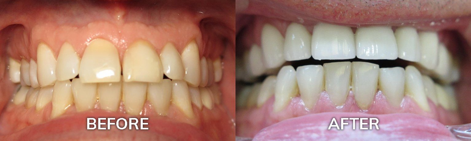 Veneers | Before and After Photo | Family Dentist Tuscaloosa AL