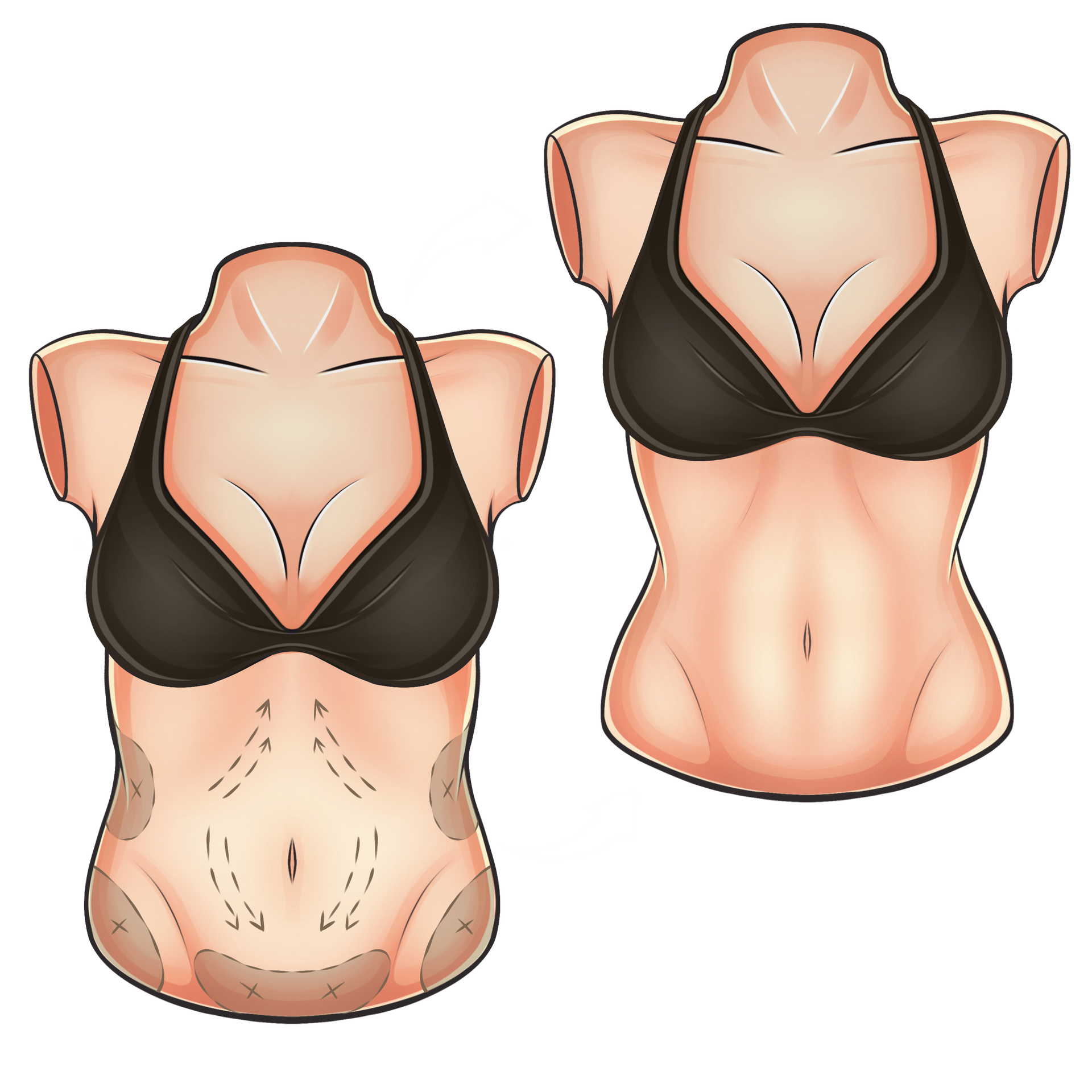 Um desenho do torso de uma mulher com setas apontando para diferentes áreas.