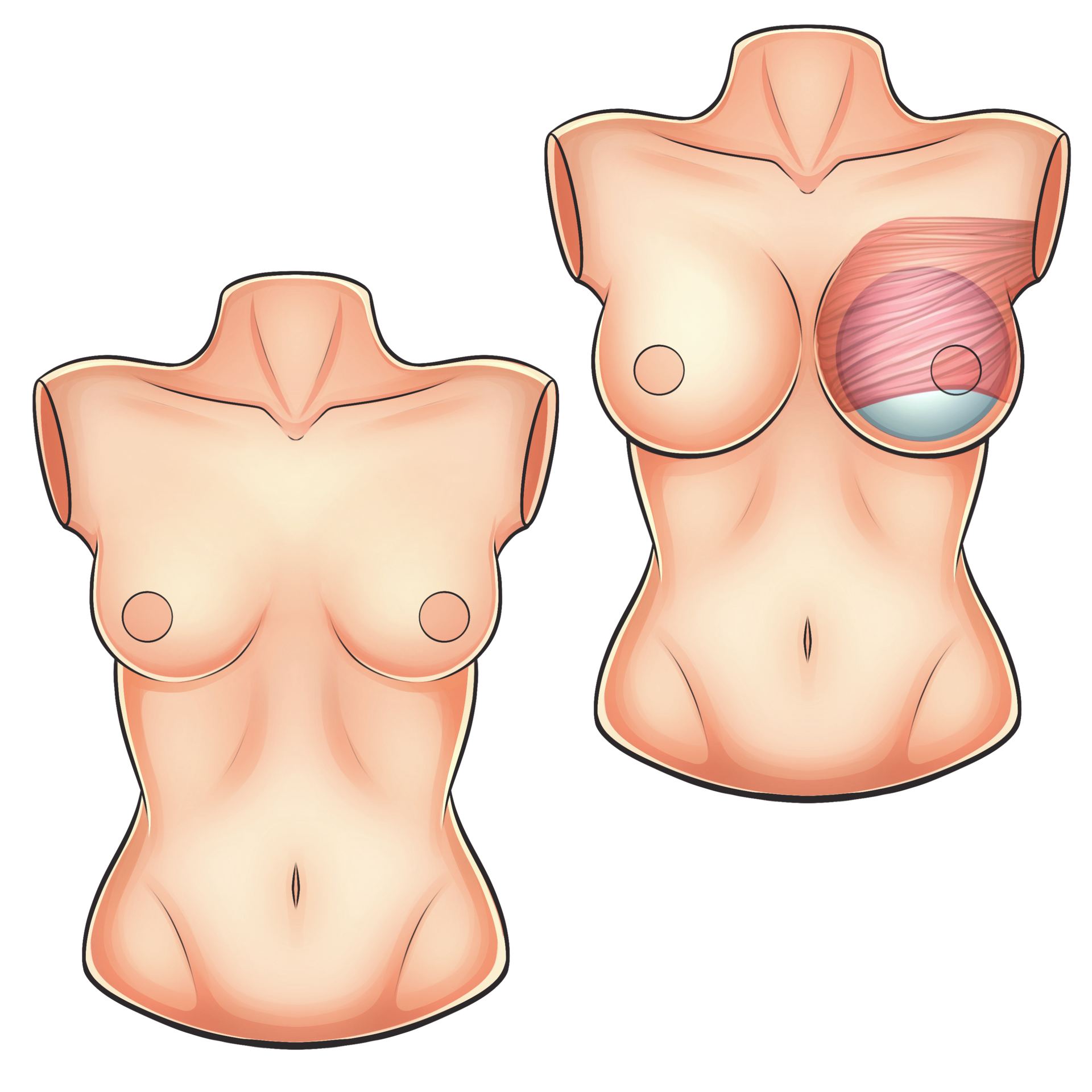 Mamoplastia de aumento