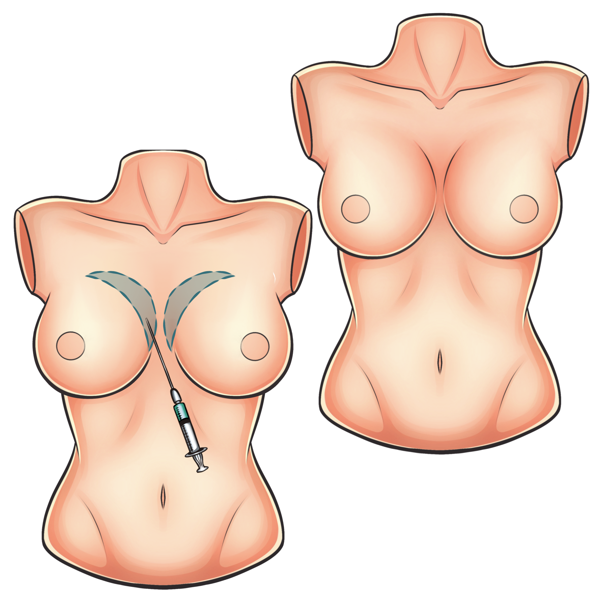 Mamoplastia híbrida
