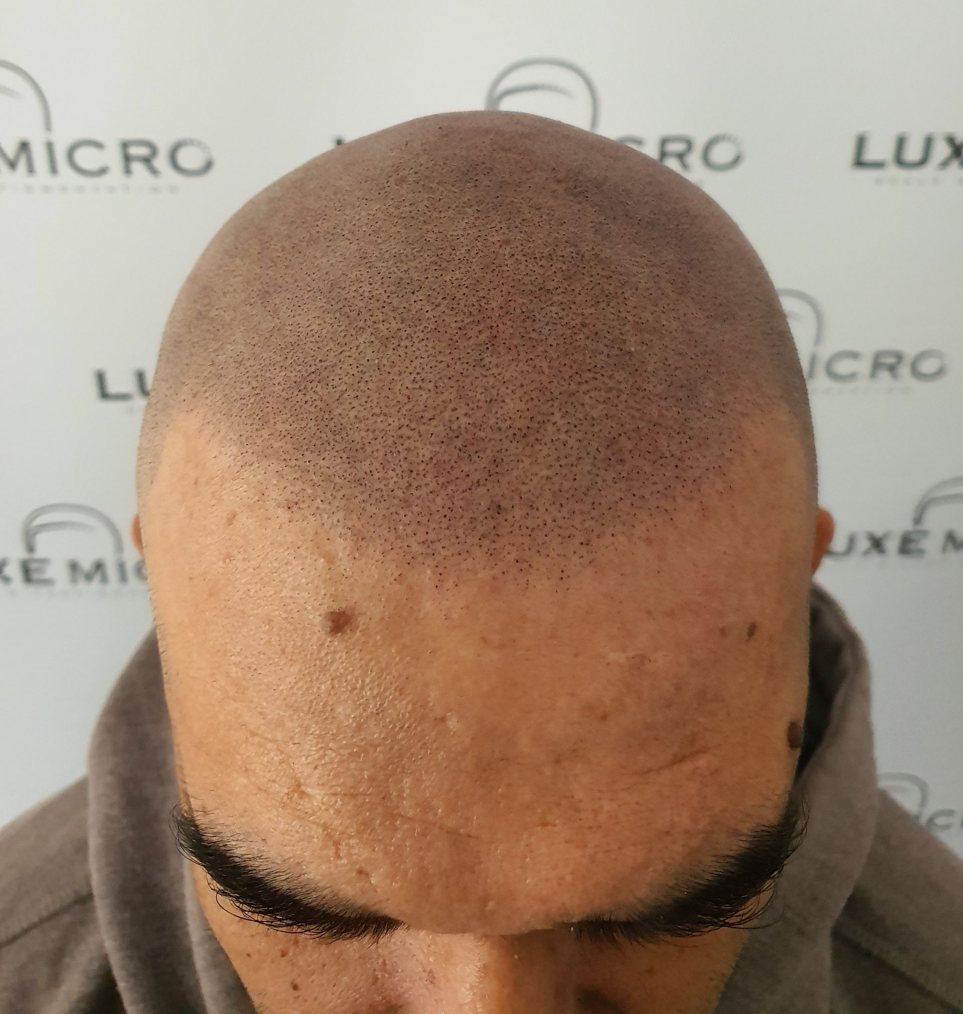 Scalp Micropigmentation