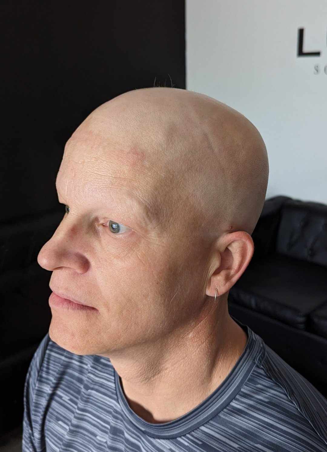 Hair tattoo for alopecia before example