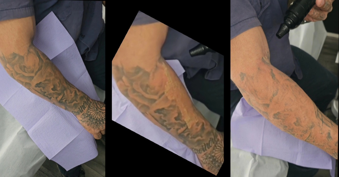 Tattoo removal before/after examples