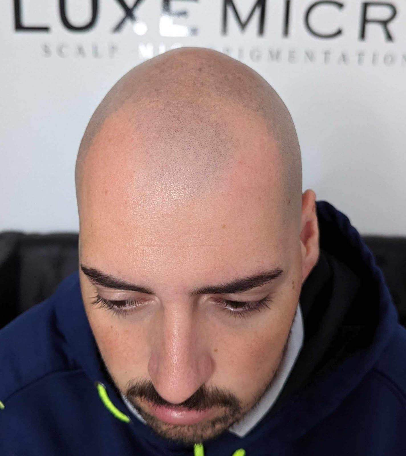 Scalp Micropigmentation for Men Before Treatment