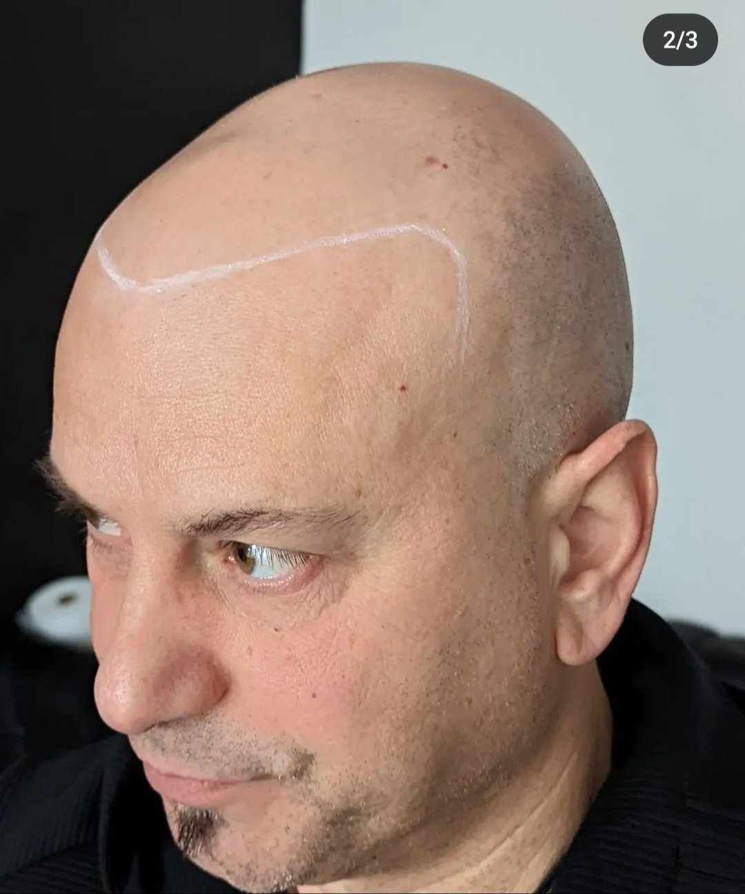 Scalp Micropigmentation for Men Before Treatment