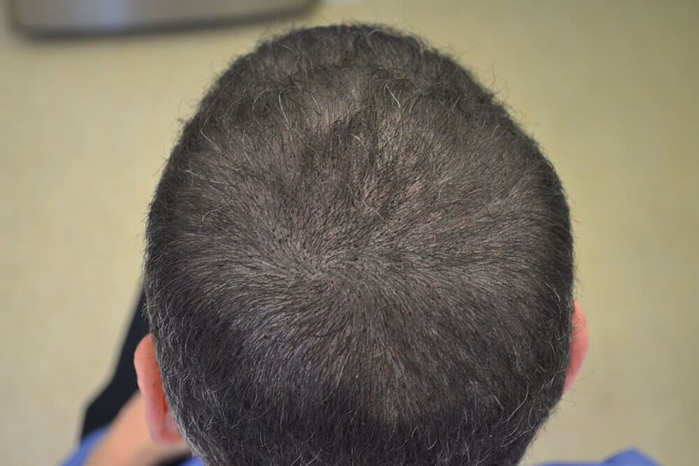 Scalp Micropigmentation