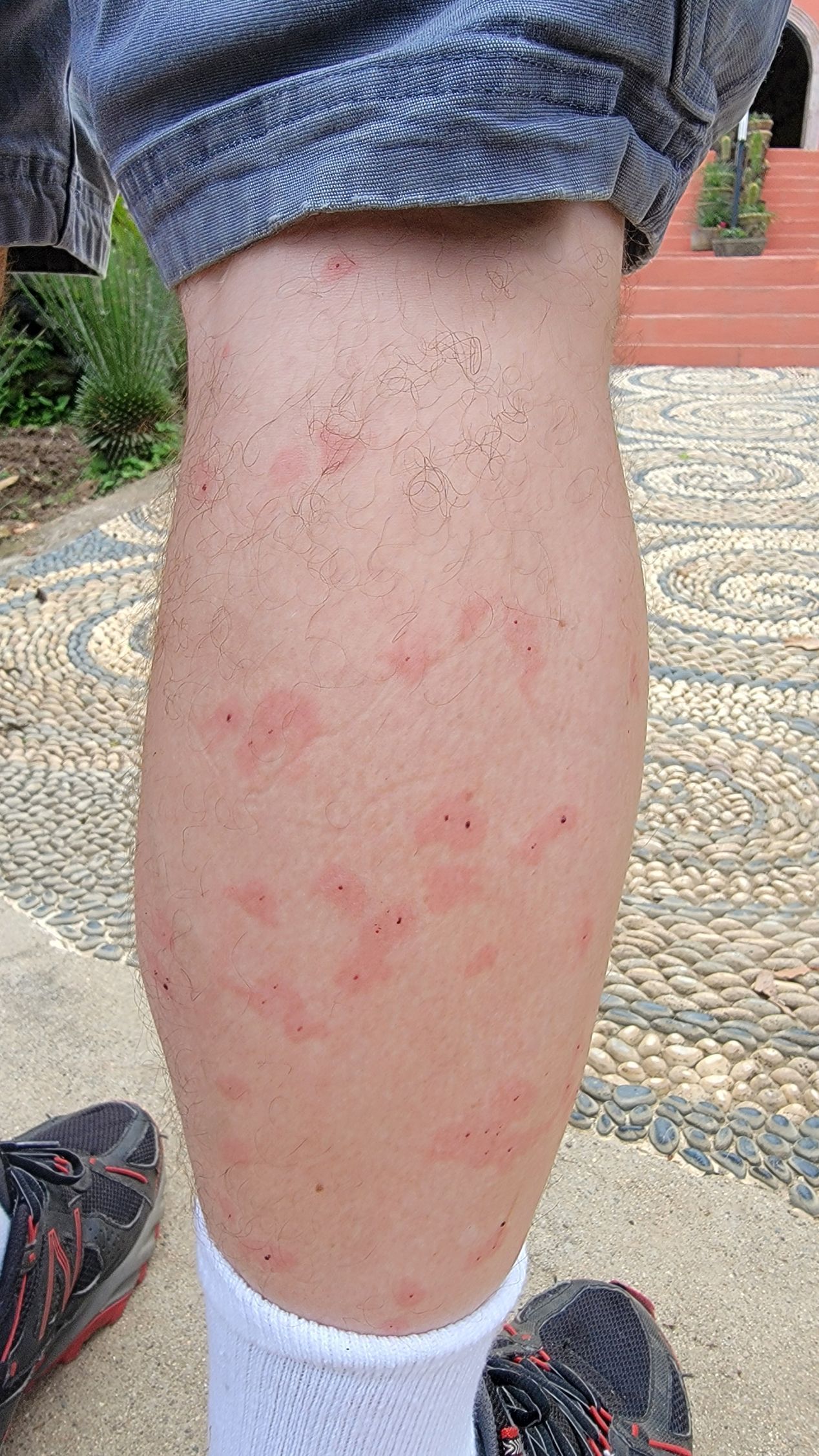 Leg with multiple red, raised, and possibly itchy skin lesions.
