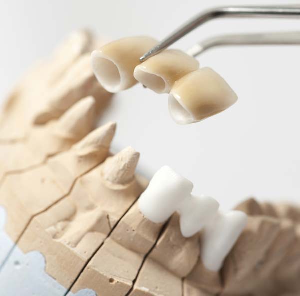 Dental Bridges