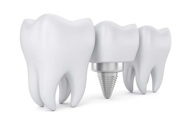 Dental Implant