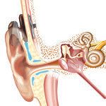 bone conduction implant