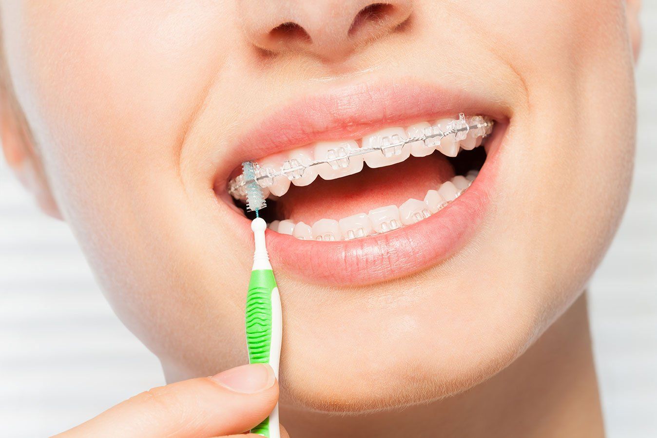 A woman with braces is brushing her teeth with an interdental brush.
