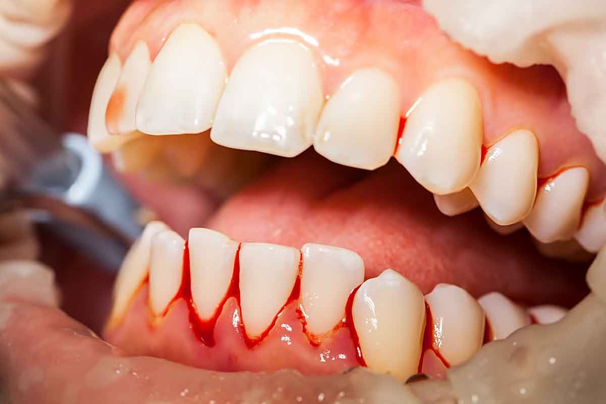 gums bleeding when flossing