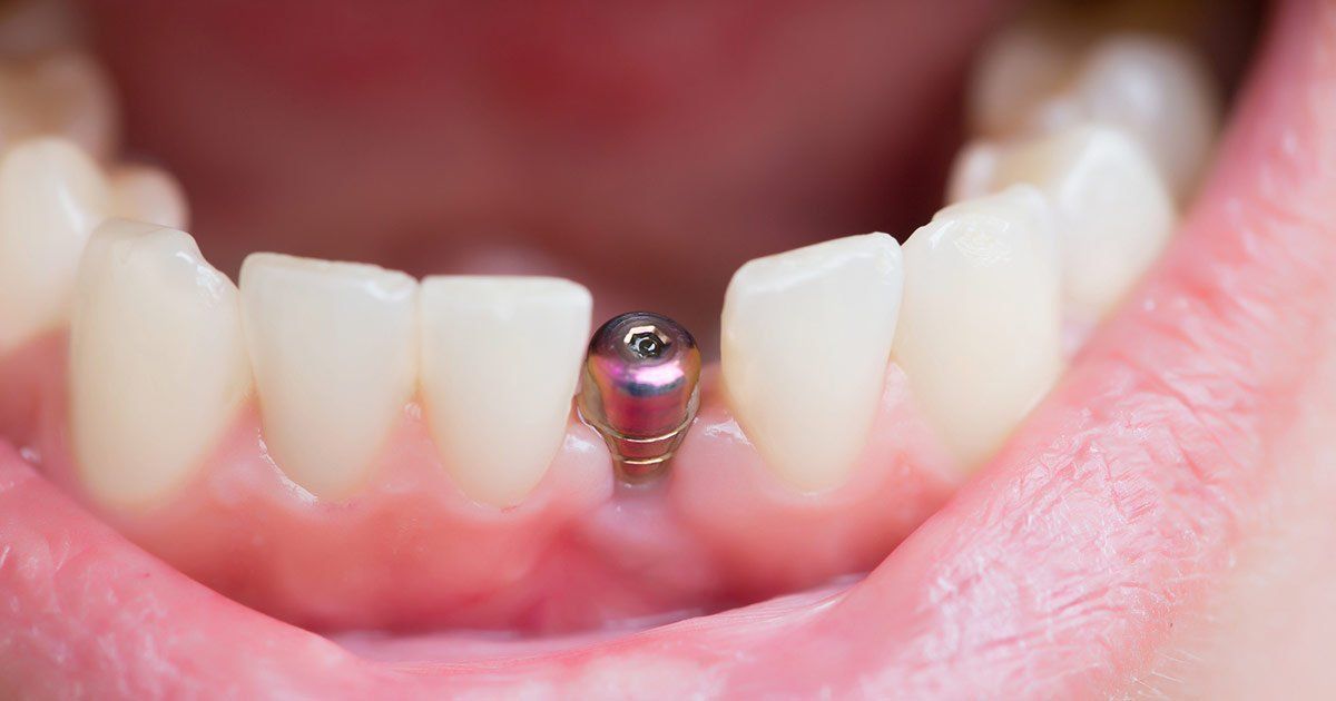 Dental Implants , dentist in tarrytown ny