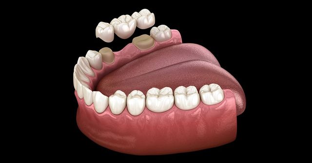 What Is the Difference Between a Dental Bridge and a Crown?