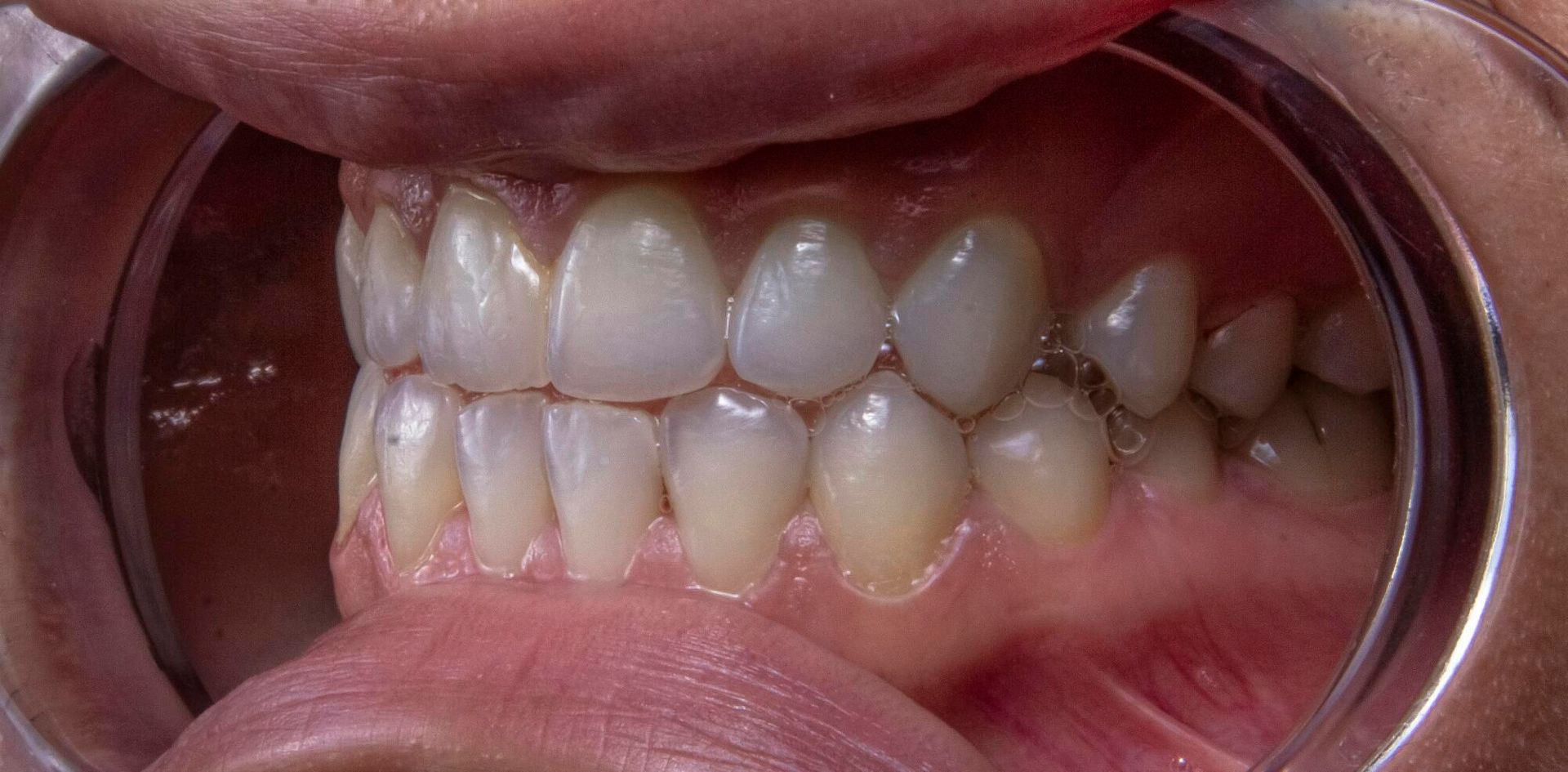 Teeth inside a mouth, dental exam. Showing upper and lower teeth.