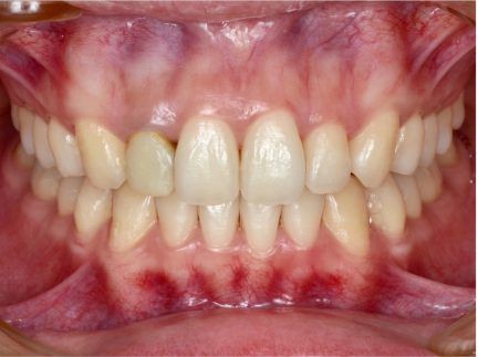 A close up of a person 's teeth with red spots on them