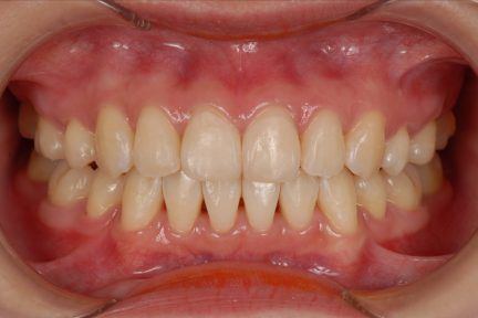 A close up of a person 's teeth with a mouth guard.