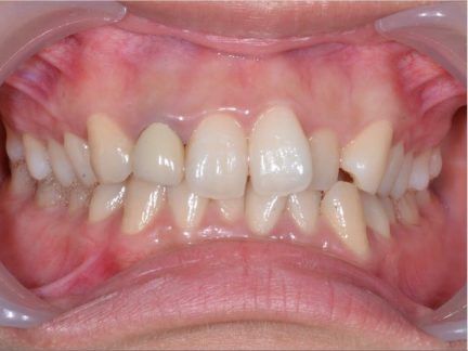 A close up of a person 's teeth in a mouth guard.