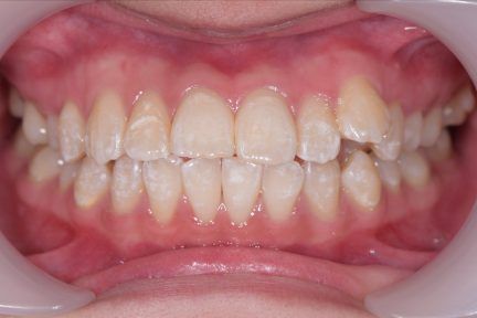 A close up of a person 's teeth with white teeth.