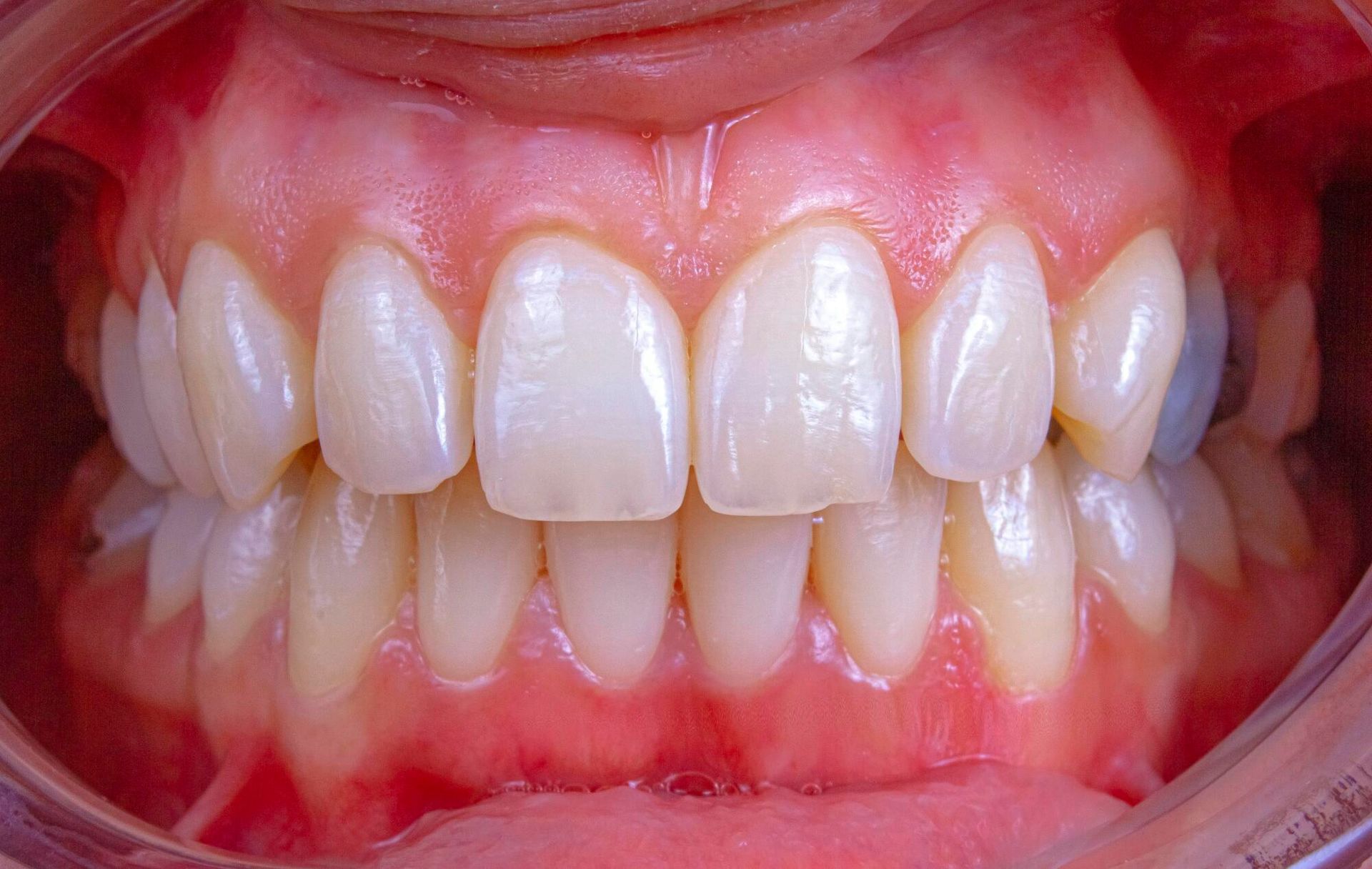 A close up of a person 's teeth and gums.