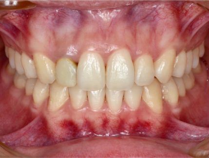 A close up of a person 's teeth with red spots on them