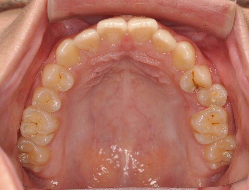 A close up of a person 's teeth and mouth.